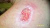 October 13, 2012      24 hours after canna-vaseline.jpg