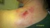 October 21, 2012     9 days after canna-vaseline.jpg