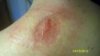 October 24, 2012     12 days after canna-vaseline.jpg