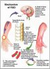 mechanism of RSD.jpg